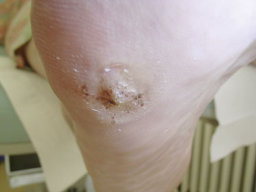 Warzenbehandlung